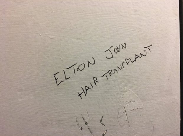 "Elton John Hair Transplant"